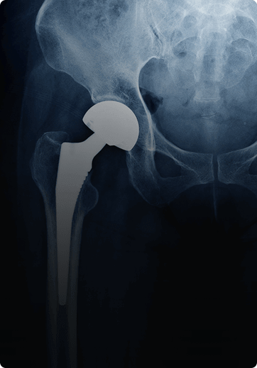 Joint Replacement