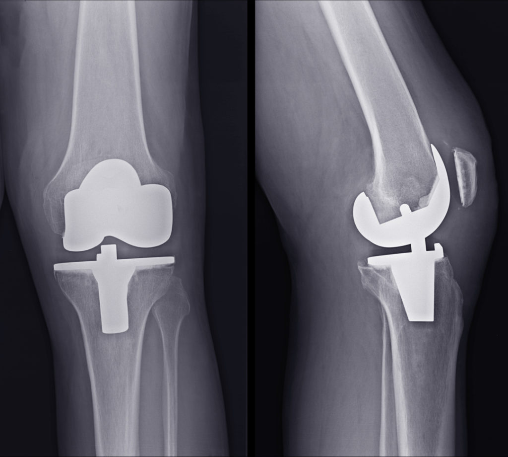Total Knee Replacement