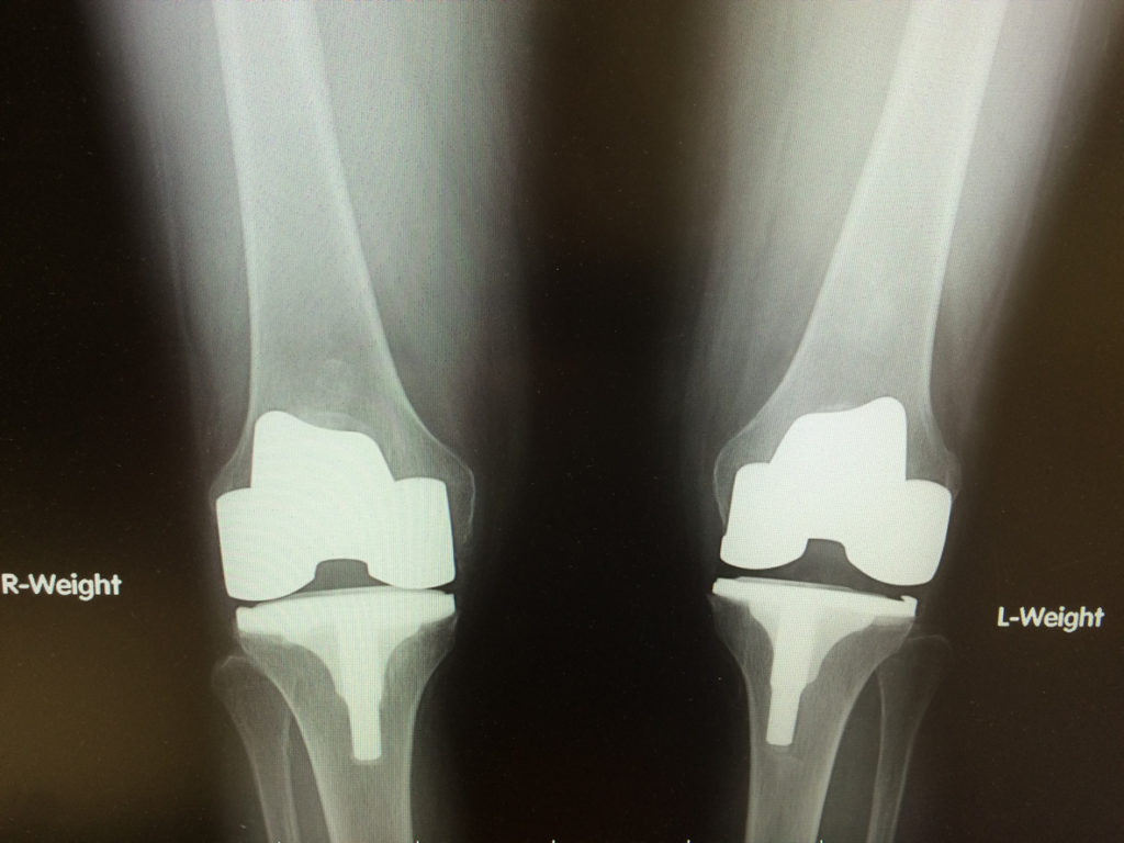 Full vs. Partial Knee Replacement