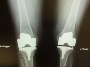 Full vs. Partial Knee Replacement