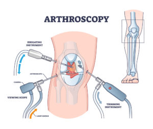 Details about Arthroscopic surgery