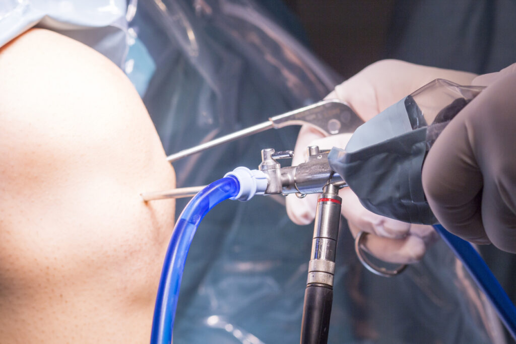 knee arthroscopy micro surgery in hospital