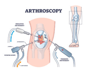 Arthroscopy procedure as knee diagnostics process explanation