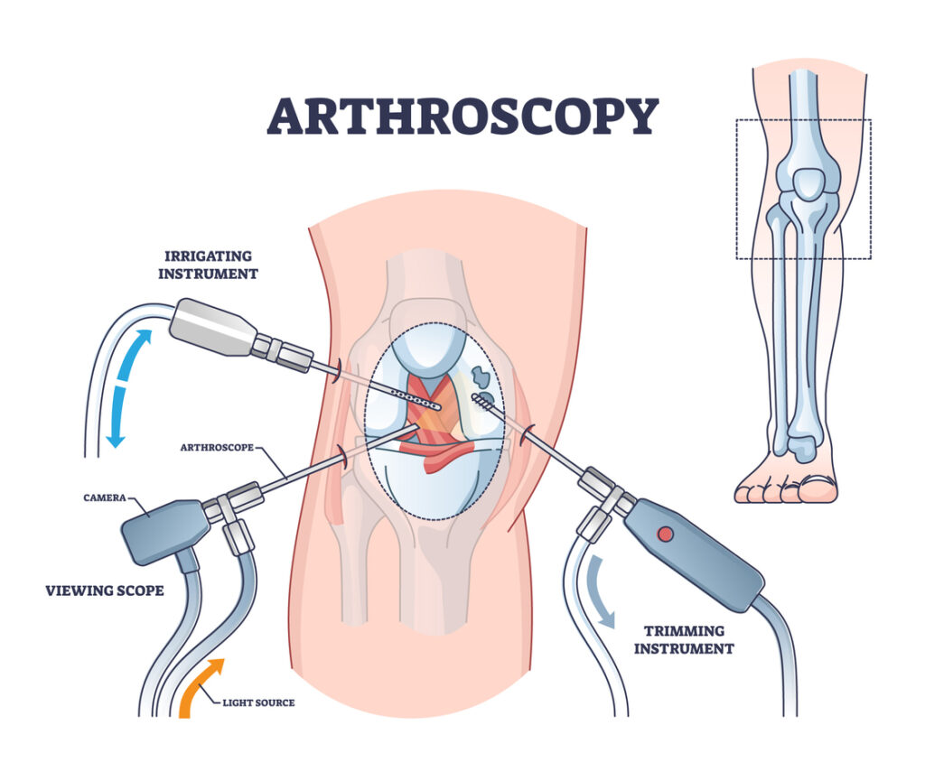 Arthroscopy procedure as knee diagnostics process explanation