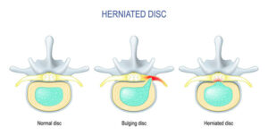 Difference Between Bulging disc and Herniated Disc
