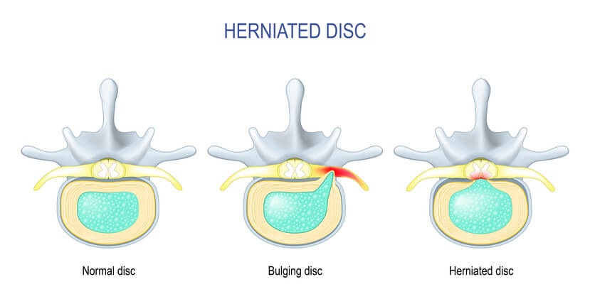 Difference Between Bulging disc and Herniated Disc