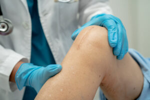 oman patient scars surgical total knee joint replacement Suture