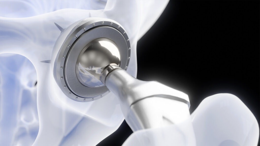 An X-ray image showing the details of a hip implant used in hip replacement surgery.