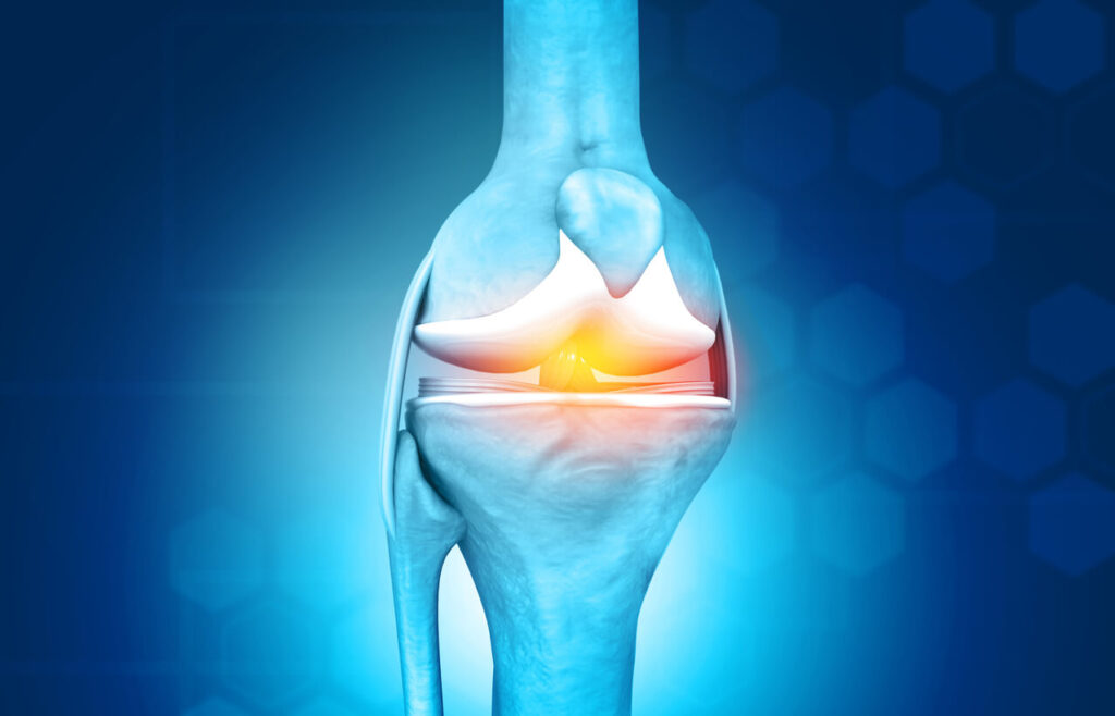 Knee pain from Meniscus Tear