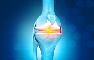 Knee pain from Meniscus Tear